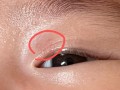 新生儿眼皮上长小红点是正常现象还是疾病信号？需要担心吗？