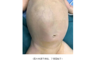 新生儿巨结肠到底有多危险？不及时治疗会影响孩子一生吗？