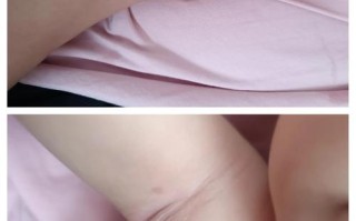 新生儿胳肢窝有白色泡
