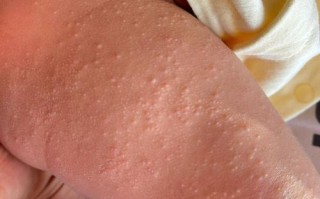 新生儿腿上长了小白点