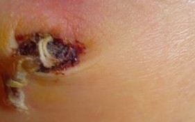 新生儿肚脐眼结痂一直不掉，是正常现象还是需要干预？