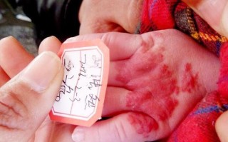 新生儿手上的红色斑块是正常现象还是疾病信号？需要担心吗？