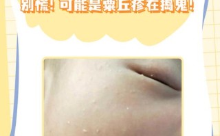 儿童脸上长小米粒疙瘩