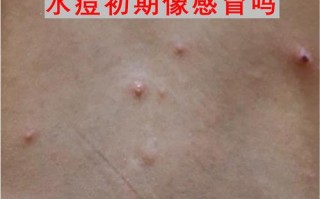 儿童水痘初期图片长什么样？不同阶段症状如何区分？