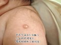 新生儿卡介苗接种后化脓破溃了，这正常吗？需要如何护理？