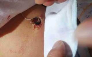 新生儿十一天肚脐出血是正常现象还是异常信号？该如何正确处理？