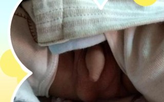 新生儿睾丸一个大一个小是正常现象吗？需要就医检查吗？