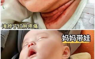 新生儿闪到脖子后如何正确处理？需要立即就医还是家庭护理？