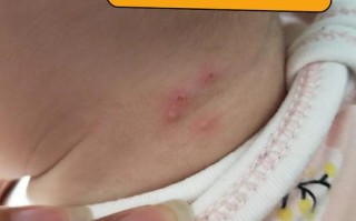 儿童长脓包疮怎么治疗？家庭护理与药物选择要注意什么？