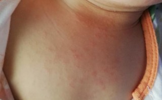 新生儿感冒的症状表现有哪些？家长该如何区分与普通感冒的差异？