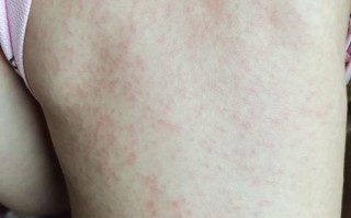 儿童起疹子有哪些常见症状？不同皮疹图片如何区分？