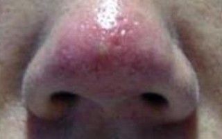 孕期鼻头变红是激素变化还是皮肤敏感在作祟？