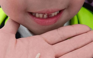 儿童侧切牙6岁就掉是正常现象吗？需要干预吗？