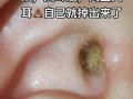 儿童耳屎成硬块 香油
