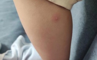 儿童出水痘初期症状有哪些典型表现？家长该如何及时识别与应对？