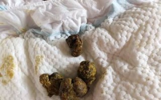 新生儿大便一粒一粒的是正常现象吗？需要担心消化问题吗？