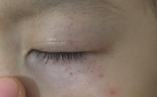 儿童发烧眼皮出现红点是何原因？需要警惕哪些疾病？