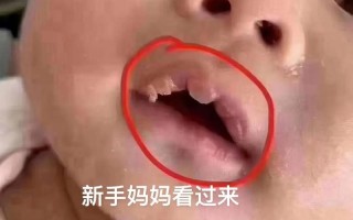 新生儿嘴上起奶泡是正常现象吗？需要处理吗？