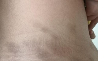 孕期身上出现褐色花斑是何原因？对胎儿健康有影响吗？