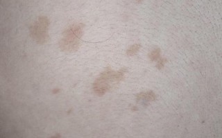 怀孕期间长汗斑是正常的生理现象还是健康预警？