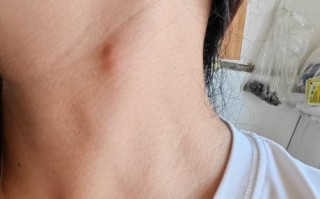 怀孕期间脖子上长痘痘是什么原因？需要特别处理吗？