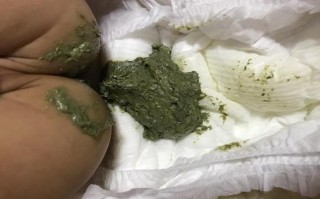 新生儿大便绿色是正常现象还是健康警报？家长该如何科学判断与应对？