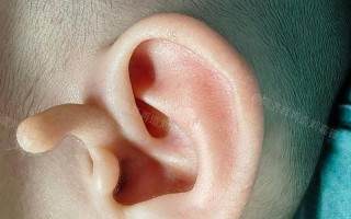 新生儿出生耳朵上有毛是正常现象还是健康异常？