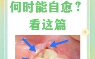 孕期智齿肿痛，能用药吗？