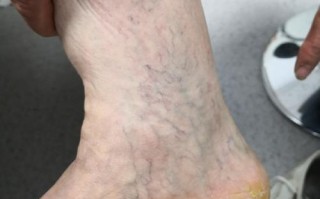 孕期小腿静脉曲张症状有哪些？如何缓解与预防？