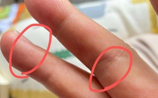 孕期手上起小水泡是湿疹还是疱疹？图片症状如何辨别？