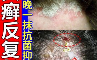 儿童头皮癣用药需谨慎，哪种药既安全又高效？家长该如何正确选择？