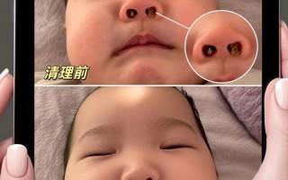新生儿鼻屎能不能挖？挖了会不会有危险？正确处理方法是什么？