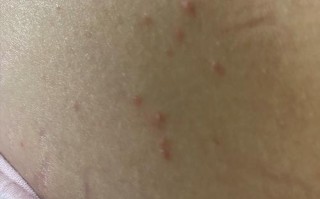 孕期身上莫名长小肉疙瘩，是激素变化还是皮肤病变？需要担心吗？