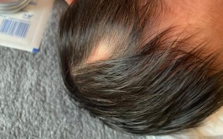 新生儿头顶无发区是正常生理现象还是需要警惕的健康信号？