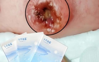 新生儿用艾叶灰包肚脐真能消毒防感染吗？科学依据与风险隐患是什么？