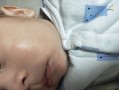 儿童嘴边长小红点图片