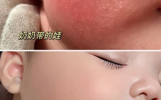 新生儿脸干起皮是缺水还是生病？如何正确护理避免皮肤受损？