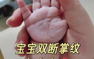 新生儿断掌是先天异常还是发育问题？需要干预吗？
