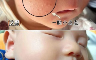 新生儿脸上长痱子怎么快速消退？日常护理要注意这几点！