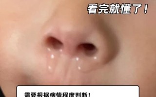 新生儿有鼻涕怎么正确清理？有哪些安全又有效的方法？