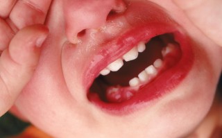 新生儿嘴唇上有红色的是怎么回事？需要担心吗？