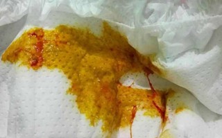 新生儿细菌性肠炎便血，该如何科学应对与护理？