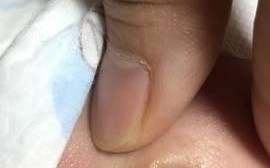 新生儿肚脐30天还没脱落，是正常现象还是需要就医处理？