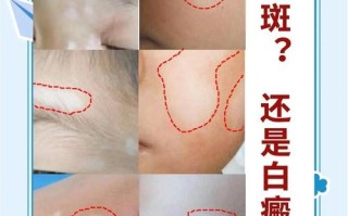 新生儿白斑是何原因？