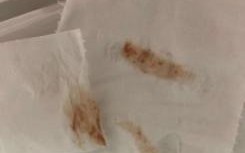 孕期出血后出现褐色分泌物，是正常生理现象还是危险信号？