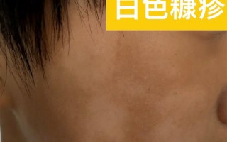 儿童白色糠疹早期症状有哪些表现？家长该如何辨别与护理？