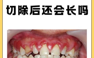 孕期牙龈增生会缩回去吗