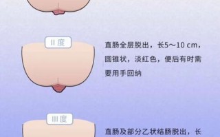 儿童脱肛有哪些典型症状？不同年龄段治疗方式有何差异？