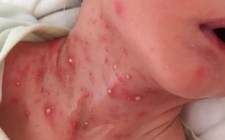 新生儿宝宝脖子长白泡是湿疹还是其他皮肤问题？需要家长如何正确护理？