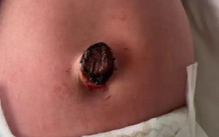 新生儿脐带未脱落有脓是感染吗？该如何处理才安全？